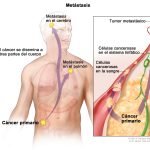 Cáncer metastásico 4 Cáncer metastásico